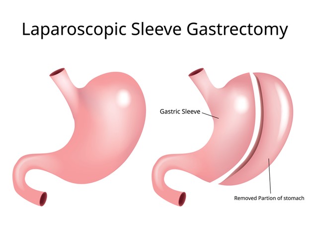 Sleeve Gastrectomy Nj Weight Loss Doctor Medical Weight Loss 