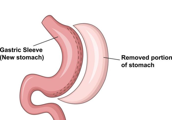Does Medicaid Cover Gastric Sleeve In Florida Tricheenlight