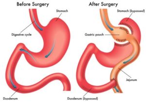 Gastric Bypass