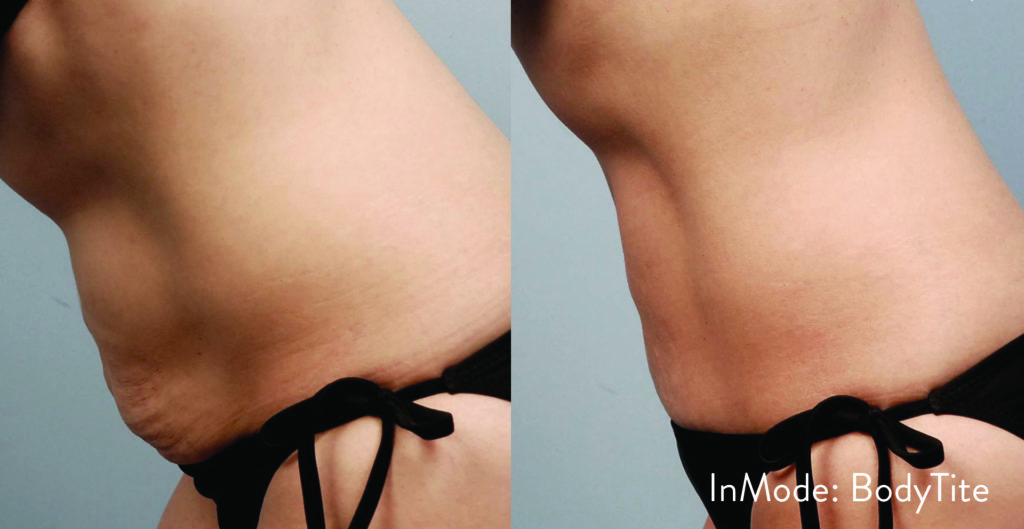 BodyTite skin tightening procedure before and after