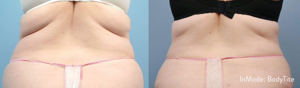 BodyTite skin tightening procedure before and after