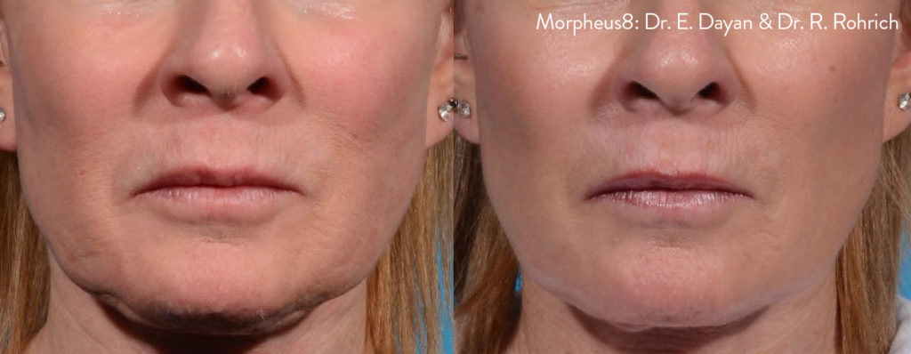 Morpheus8 Before and After Skin Tightening Treatment