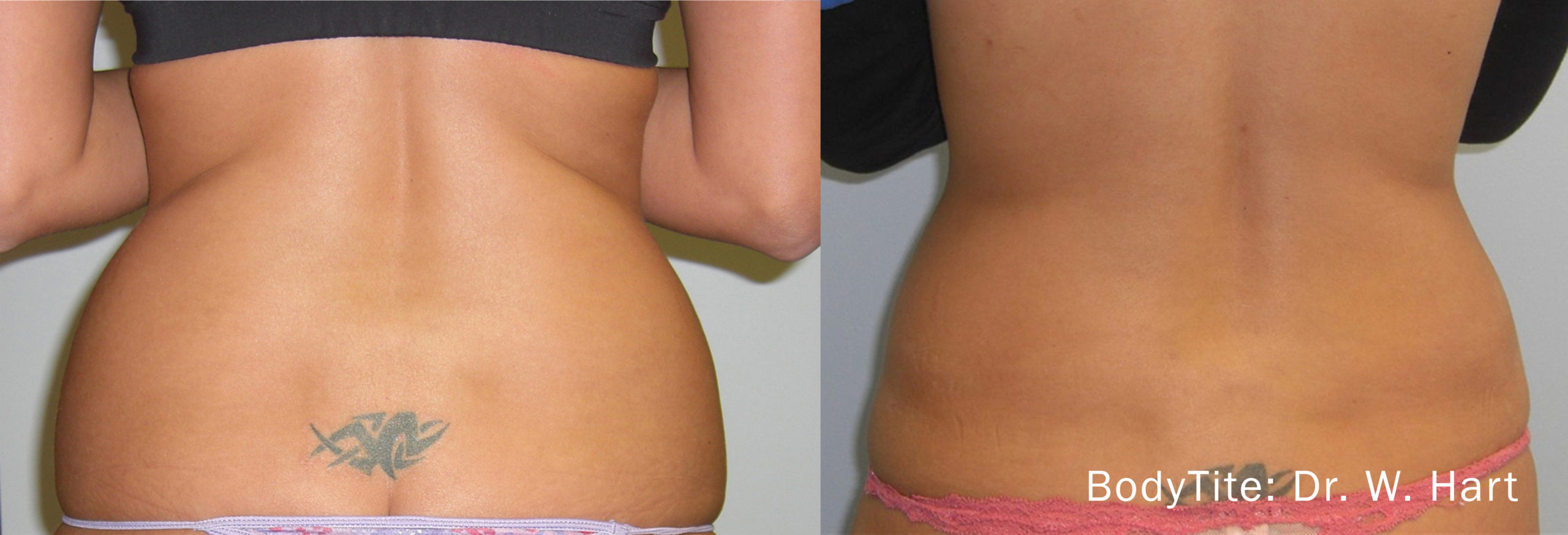 Bodytite skin tightening treatment before and after of a patient back