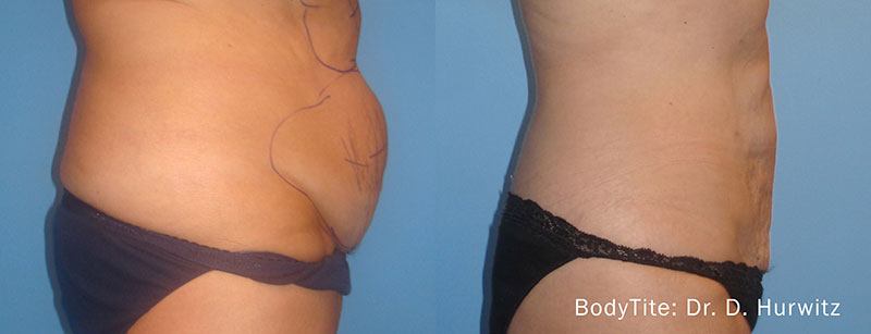 Bodytite skin tightening treatment before and after of a patients stomach and abdomen