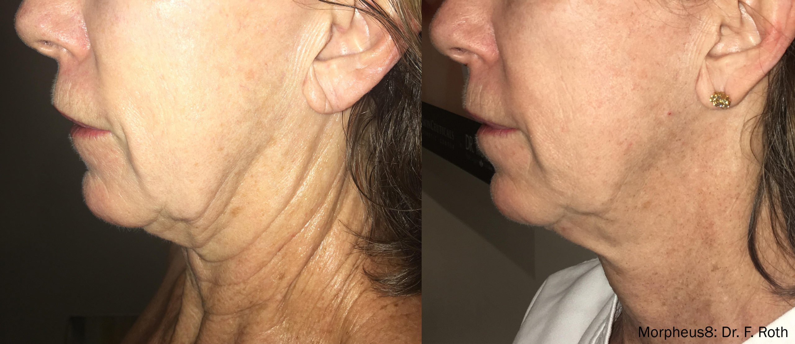 Morpheus8 skin tightening treatment on face and neck, before and after
