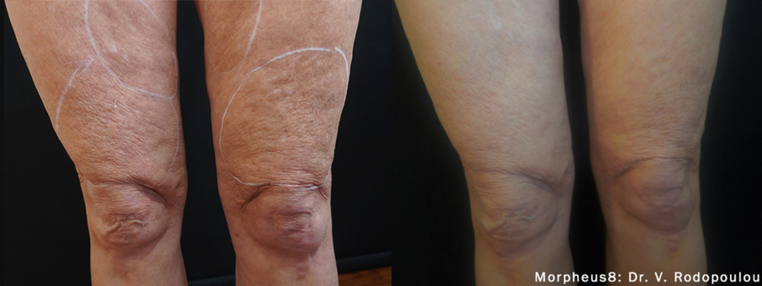 Morpheus8 skin tightening treatment on knee and thigh before and after