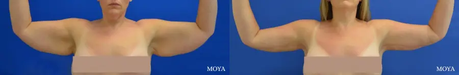 Arm Lift (MAJOR: posterior) - Before and After 1