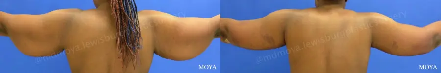Arm Lift (MAJOR: inseam) - Before and After 2