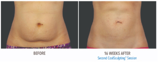 Non invasive body contouring before and after