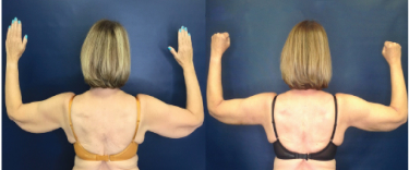 Scarless Arm Lift before and after