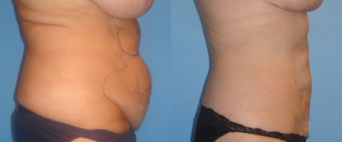 Scarless tummy tuck before and after
