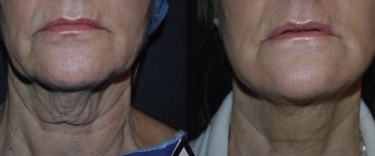 Wrinkle Reduction before and after