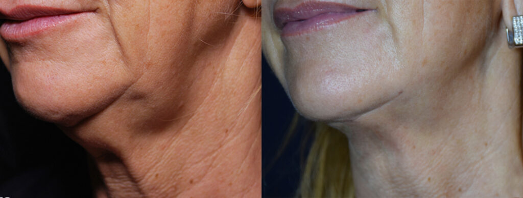 Morpheus8 Before and After New Jersey - Weight Loss and Wellness Center